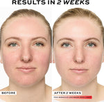Revolution Pro Miracle LED Face Mask