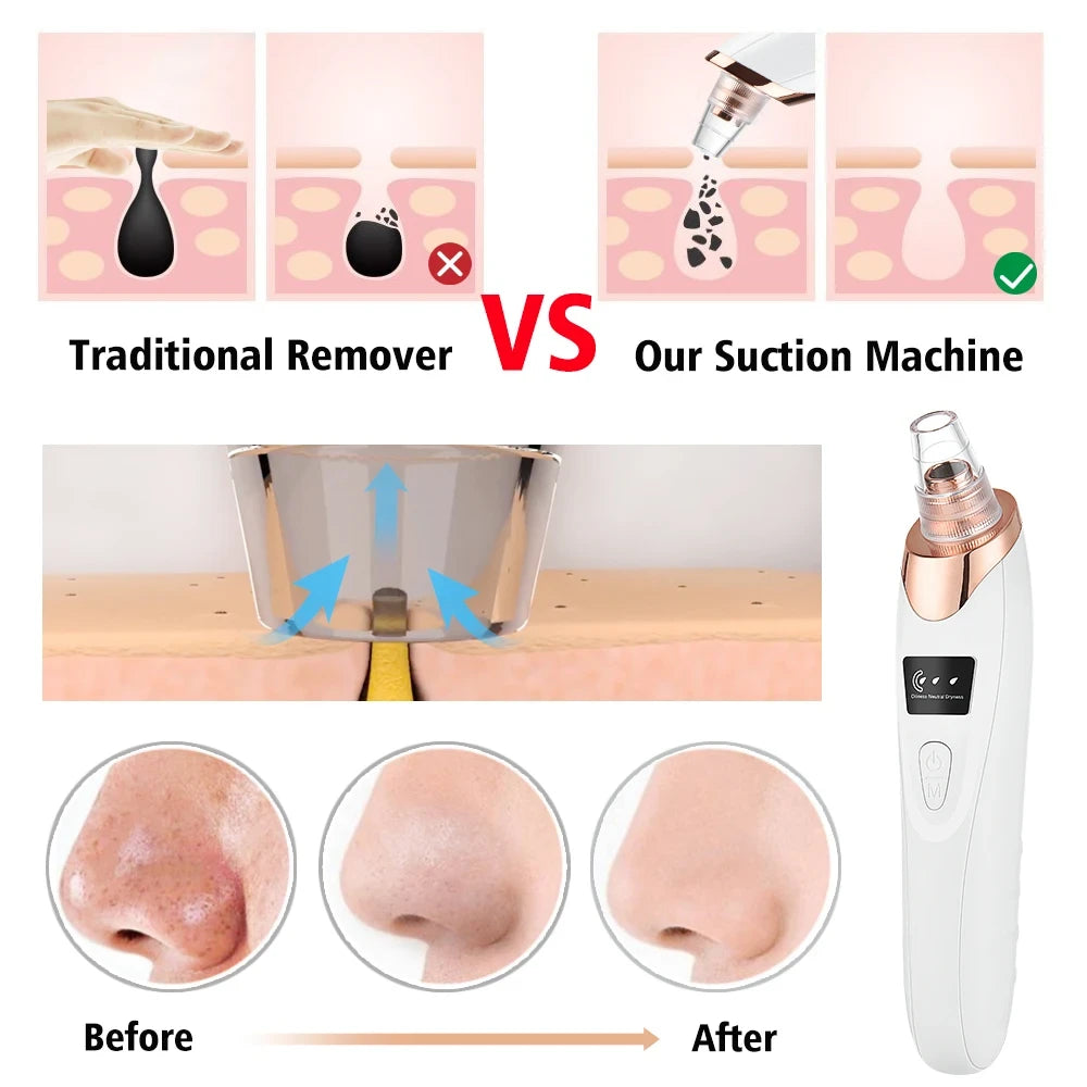 Portable Electric Blackhead Remover